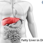 Fatty Liver in Diabetics and Its Symptoms & Preventive Steps